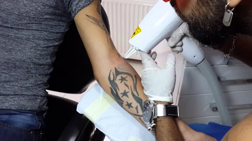 Лазер Для Удаления Тату Цена